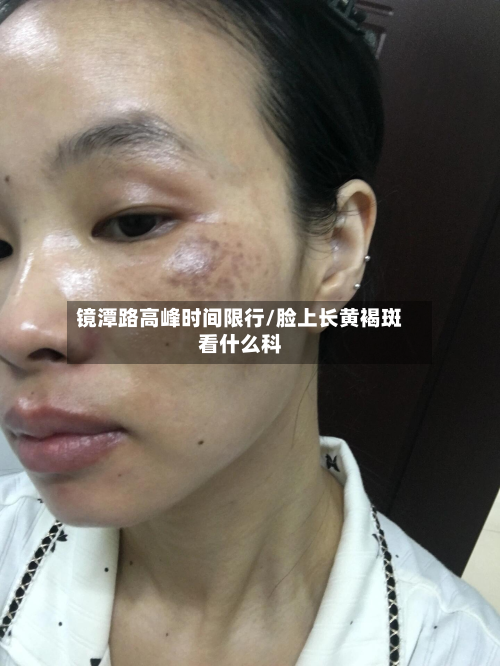 镜潭路高峰时间限行/脸上长黄褐斑看什么科-第2张图片