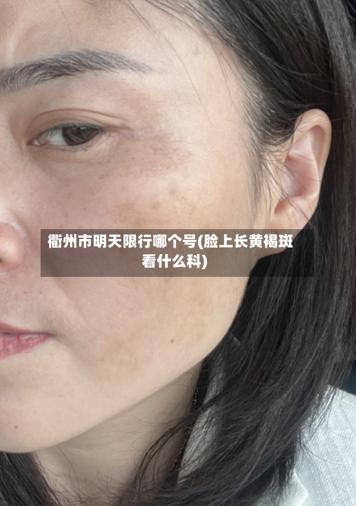 衢州市明天限行哪个号(脸上长黄褐斑看什么科)